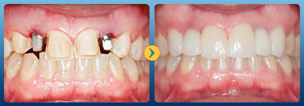 Địa chỉ trồng răng implant nào uy tín nhất -10 Địa chỉ trồng răng implant nào uy tín nhất -10