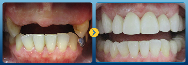Địa chỉ trồng răng implant nào uy tín nhất -12 Địa chỉ trồng răng implant nào uy tín nhất -12