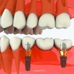 Trồng răng số 7 - Giải pháp thay thế răng tại vị trí quan trọng Trồng răng số 7 - Giải pháp thay thế răng tại vị trí quan trọng