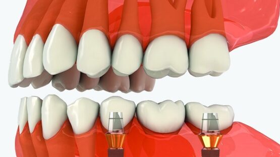 Trồng răng số 7 – Giải pháp thay thế răng tại vị trí quan trọng