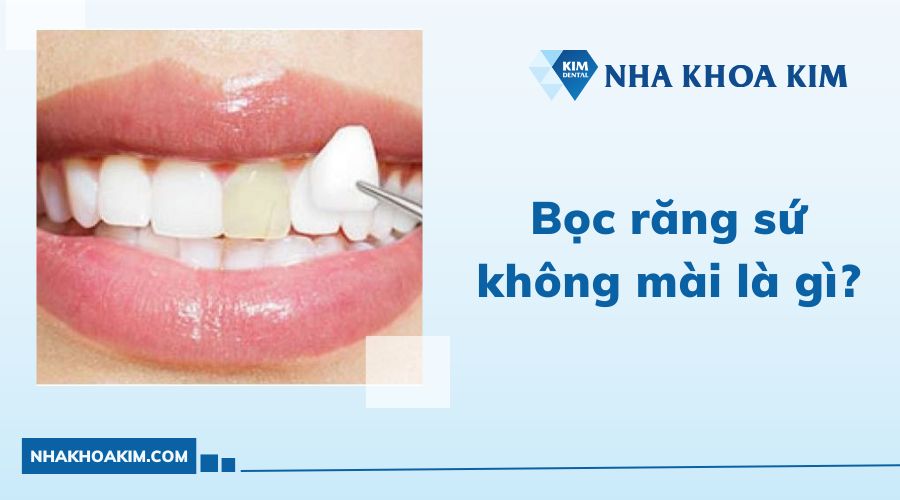 bọc răng sứ không mài là gì