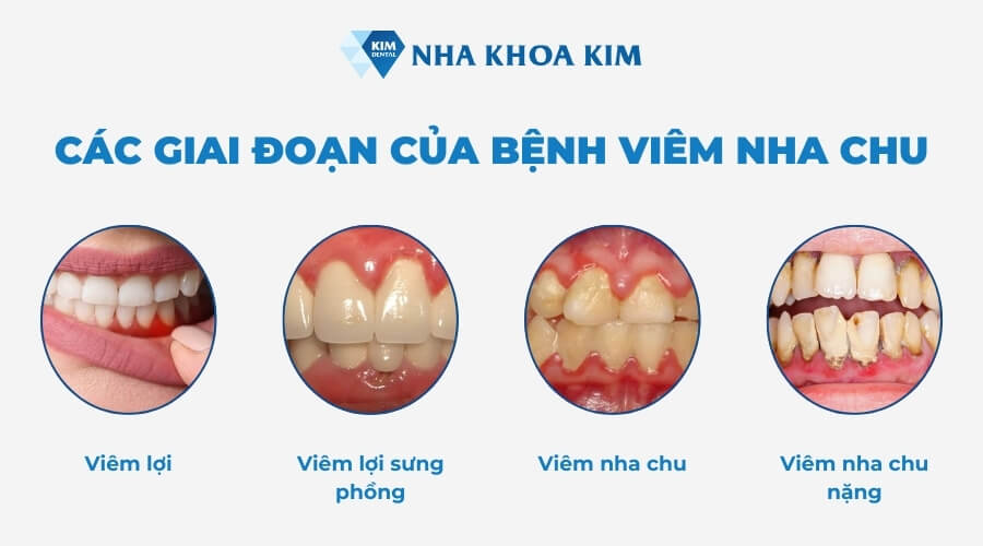 Các giai đoạn của bệnh viêm nha chu