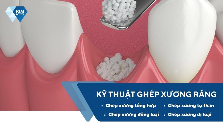 Kỹ thuật ghép xương hàm răng