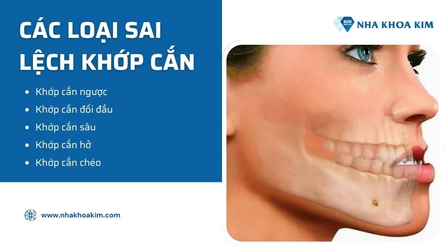 các loại sai lệch khớp cắn