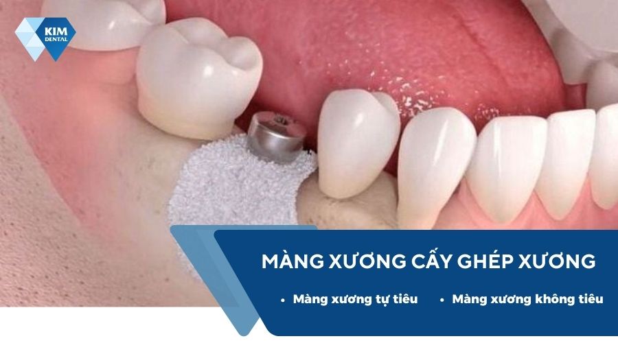 Các loại màng xương sử dụng trong cấy ghép xương
