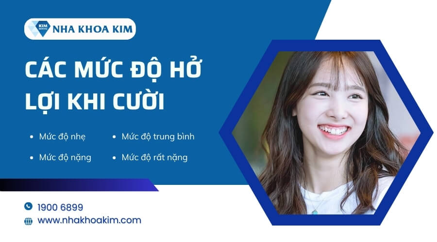 Các mức độ hở lợi khi cười