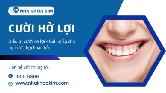 Điều trị cười hở lợi – Giải pháp cho nụ cười đẹp hoàn hảo