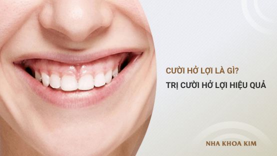 Điều trị cười hở lợi – Giải pháp cho nụ cười đẹp hoàn hảo