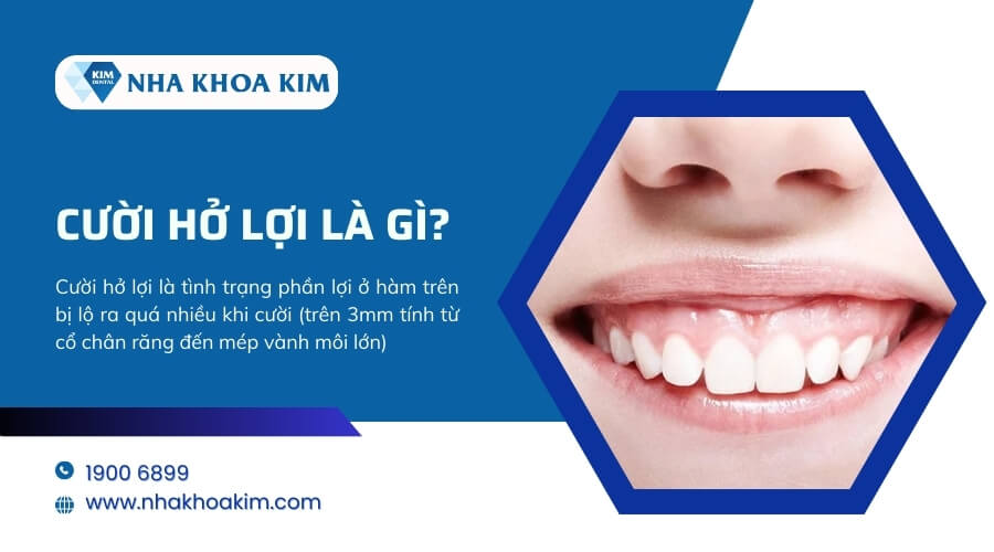 Cười hở lợi là gì?