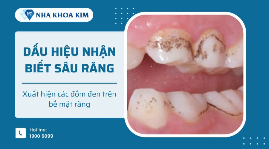 Các đốm đen trên răng là dấu hiệu cho thấy sâu răng