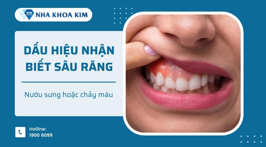 Nướu sưng hoặc chảy máu là dấu hiệu cho thấy sâu răng