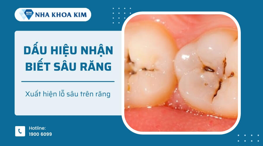 Xuất hiện lỗ sâu trên răng