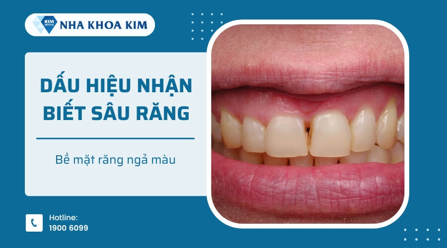 Răng có dấu hiệu ngả màu là dấu hiệu phổ biến của sâu răng