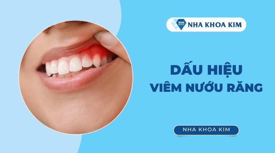 Dấu hiệu viêm nướu răng