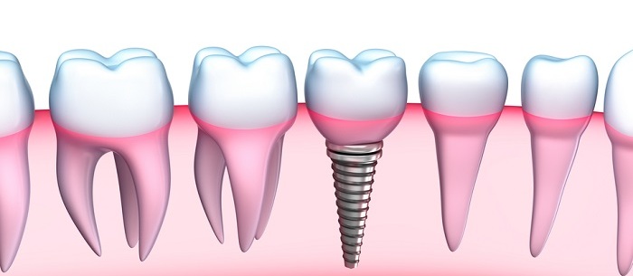 Trồng răng implant ở đâu tốt? - Tiêu chí quyết định 1