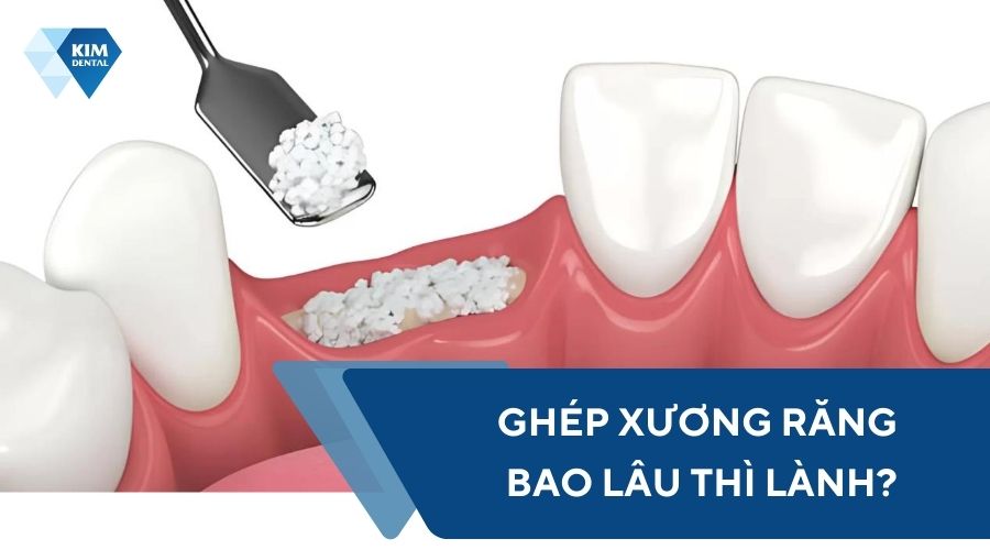 Ghép xương răng bao lâu thì lành?