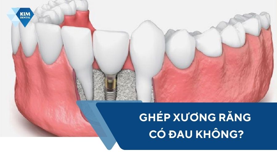 Ghép xương răng có đau không?