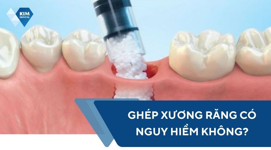 Ghép xương răng có nguy hiểm không?