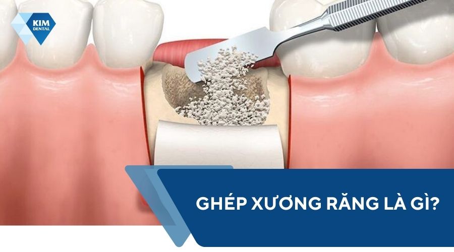 Ghép xương răng là gì?