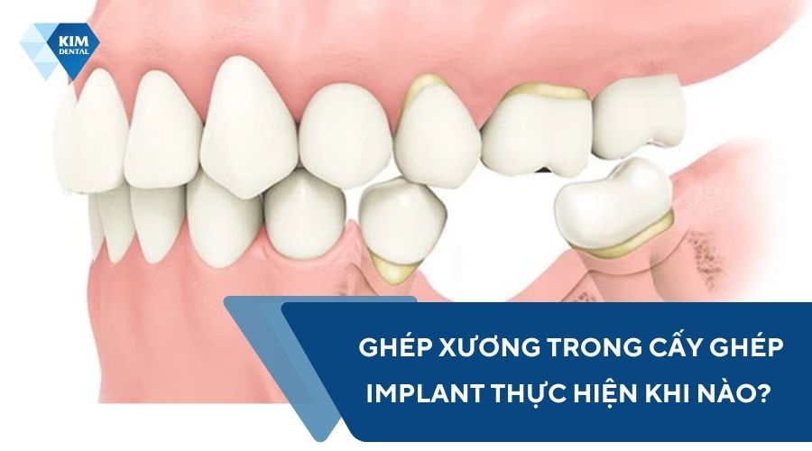 Ghép xương trong cấy ghép Implant thực hiện khi nào? 