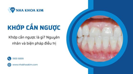 Khớp cắn ngược là gì? Nguyên nhân và biện pháp điều trị