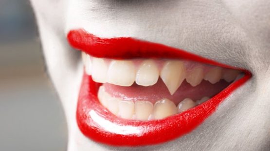 Làm răng giả vampire bằng cách nào nhanh và đẹp hiệu quả?