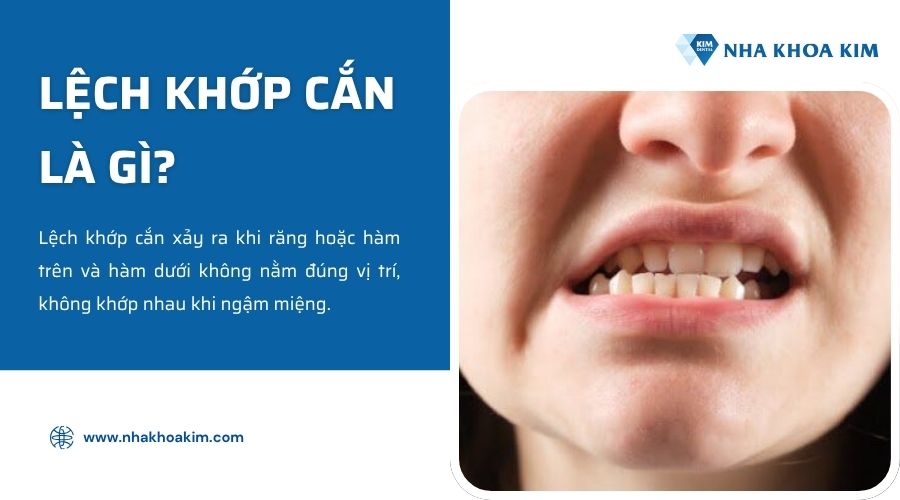 lệch khớp cắn là gì
