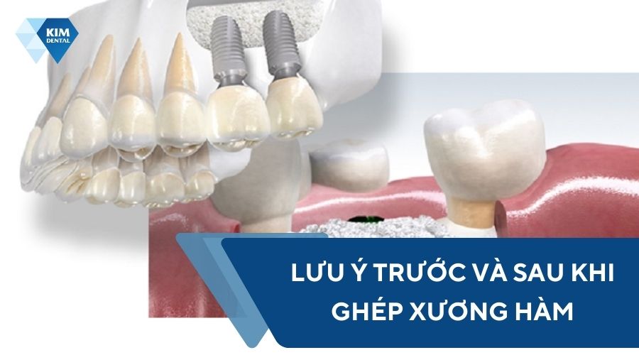 Lưu ý khi thực hiện ghép xương hàm