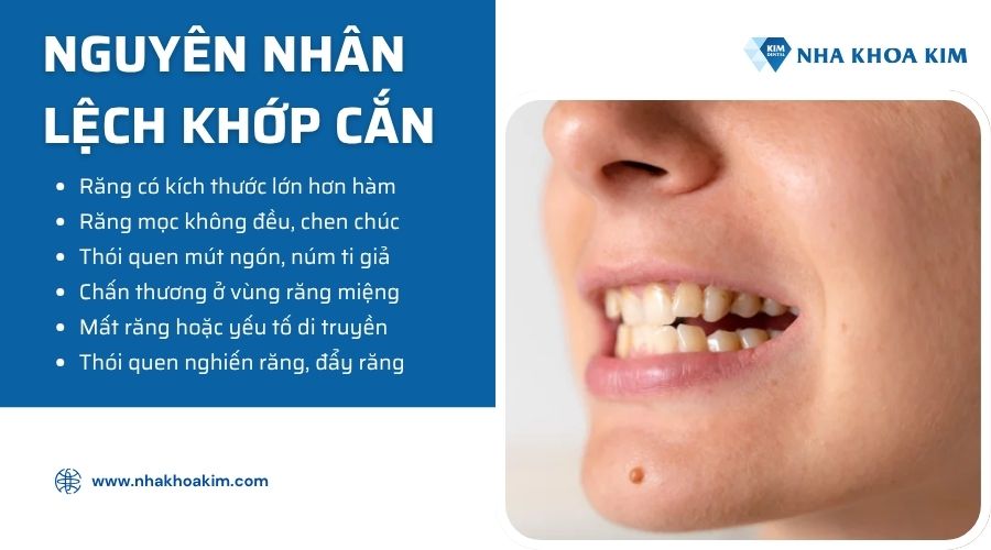 nguyên nhân bị lệch khớp cắn phải làm sao
