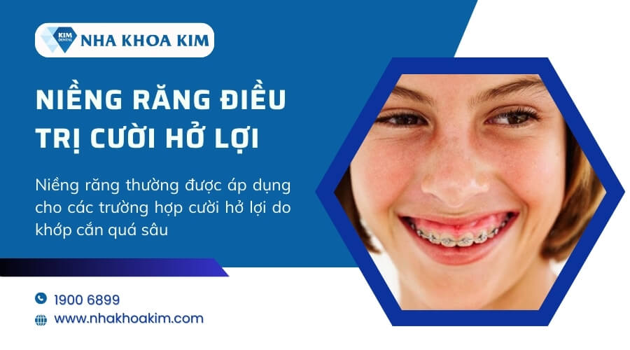 Điều trị cười hở lợi bằng phương pháp niềng răng