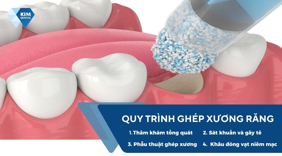 Quy trình ghép xương hàm răng