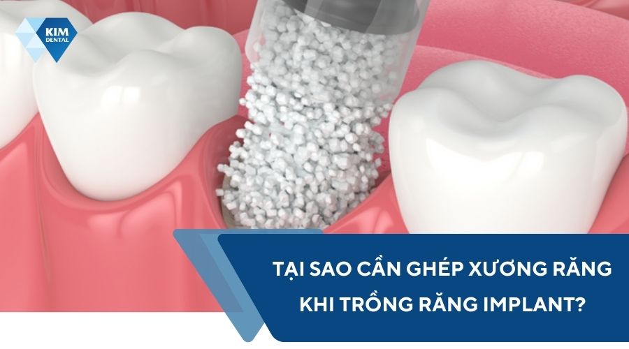 Tại sao cần ghép xương răng khi trồng răng Implant?