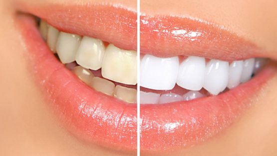 Tẩy trắng răng công nghệ hiện đại hiệu quả tại Nha Khoa Kim