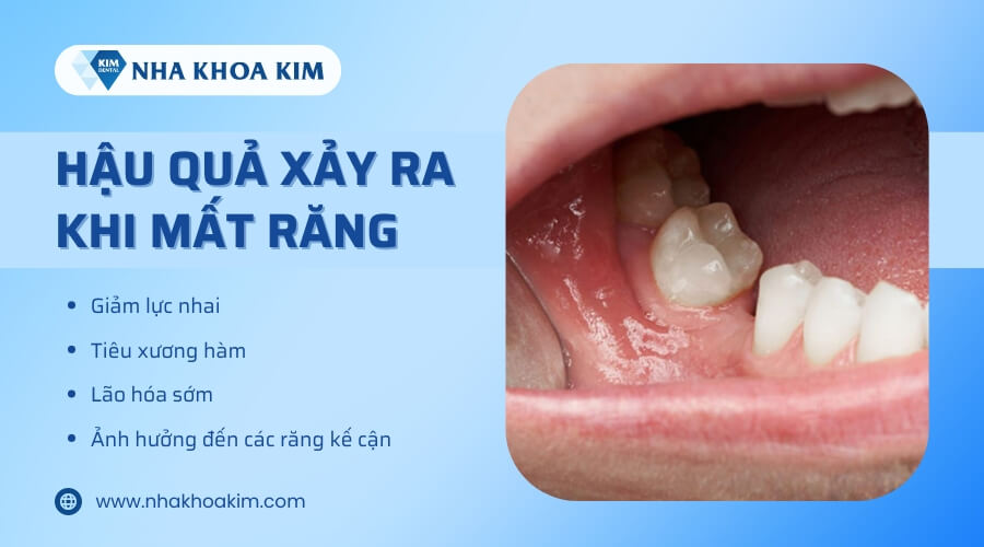 Vì sao mất răng nên trồng răng giả?