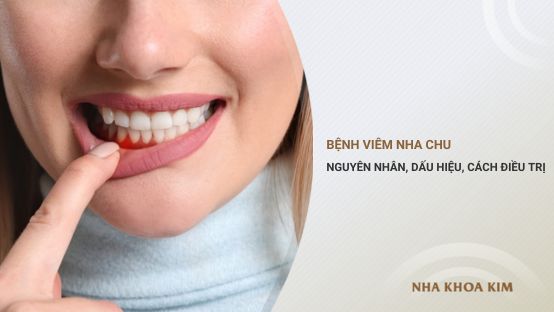 Bệnh viêm nha chu: Nguyên nhân, dấu hiệu, cách điều trị