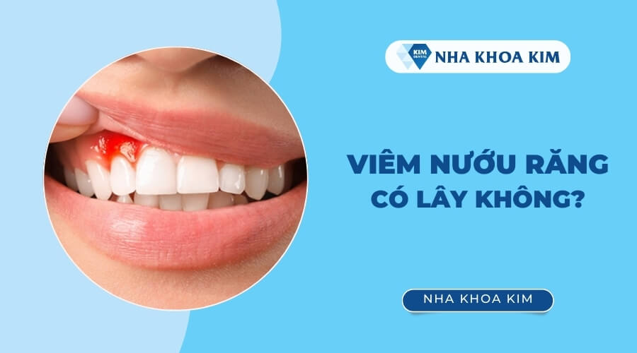 Bệnh viêm nướu có lây không?