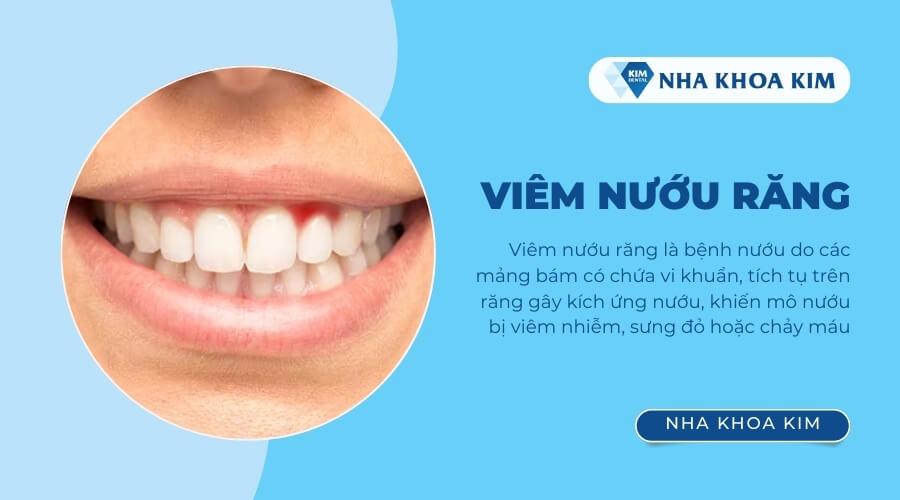 Viêm nướu là gì?