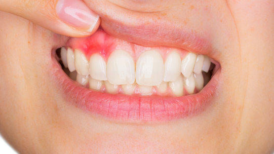 Điều trị viêm nha chu – Giải pháp giúp bảo vệ sức khỏe răng hàm hiệu quả