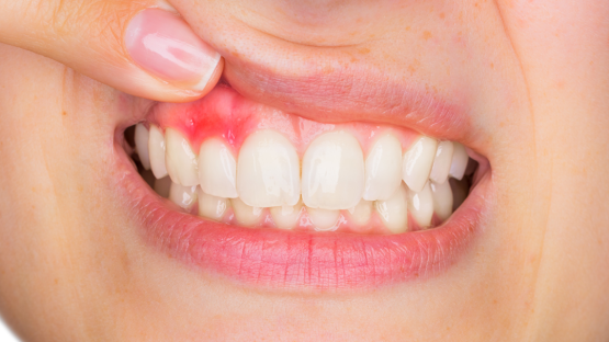 Điều trị viêm nha chu – Giải pháp giúp bảo vệ sức khỏe răng hàm hiệu quả