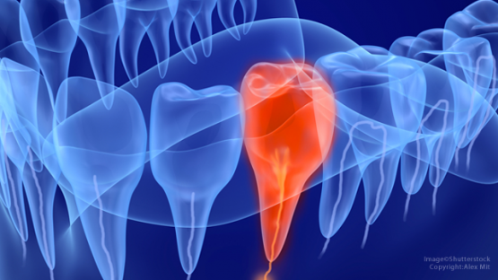 Chữa trị tủy răng – Giải pháp bảo tồn răng hiệu quả tối ưu