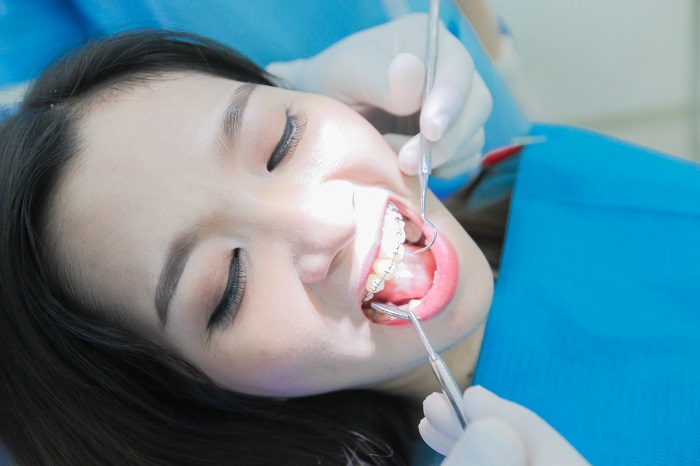 Tư vấn niềng răng - Thông tin giải đáp từ chuyên gia Nha Khoa KIM 9