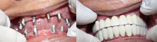 Thực hiện trồng răng implant nguyên hàm -1