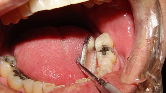 Ảnh hưởng sâu răng như thế nào tới sức khỏe răng miệng