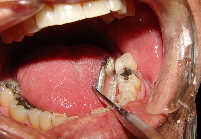 Ảnh hưởng sâu răng thế nào tới sức khỏe? 