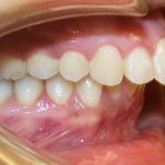Địa chỉ phẫu thuật hàm hô, vẩu ở đâu uy tín nhất hiện nay? Địa chỉ phẫu thuật hàm hô, vẩu ở đâu uy tín nhất hiện nay?