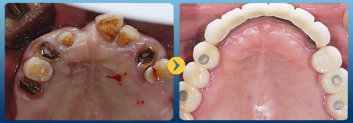 bọc răng sứ cho răng bị mẻ 1