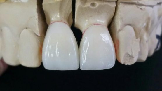 Bọc răng sứ Emax – Giải pháp xóa khuyết điểm răng xấu hiệu quả