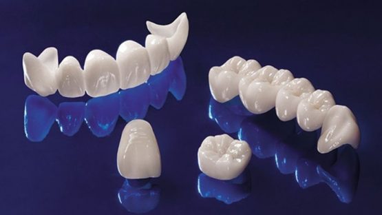 Tư vấn răng sứ – Giải đáp từ A – Z bởi các chuyên gia
