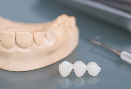 Bọc răng sứ nguyên hàm giá bao nhiêu tiền tại Nha Khoa Kim