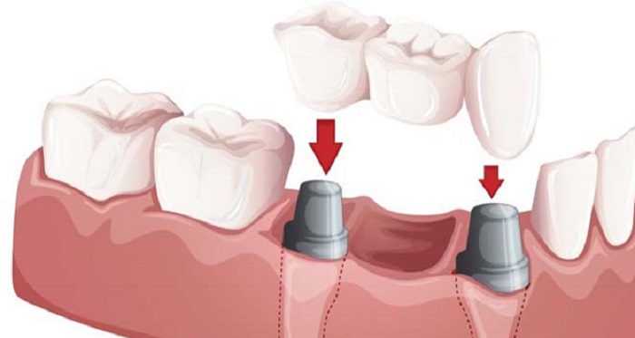 giá cấy răng implant bao nhiêu tiền